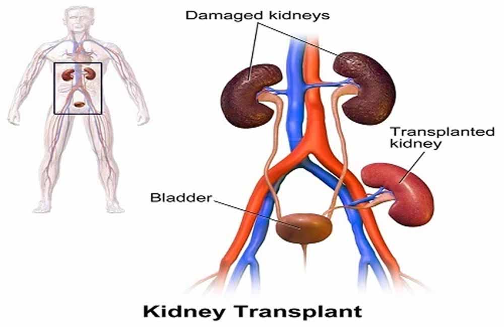 কিডনি প্রতিস্থাপন | Kidney Transplantation